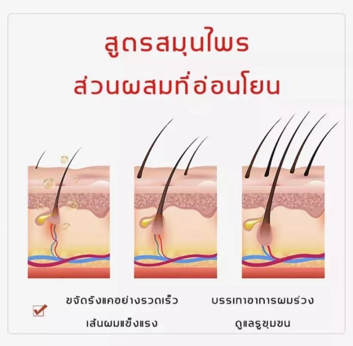 ป้องกันรังแคและลดความมัน-oushlian-ดูแลรูขุมขน-สูตรสะอาด-เชื้อราบนศีรษะ-แชมพูไม้วอมวูด-มีรังแค-บำรุงหนังศีรษะ-แชมพูขจัดรังแค-แชมพูไม้วอร์มวูด-แชมพูรักษารังแค-แชมพูแก้รังแค-แชมพูยาเชื้อรา-แซมพูขจัดรังแค