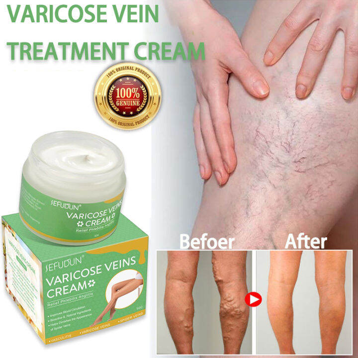 SEFUDUN Varicose Vein Treatment Cream Original Effective Spider Vein ...