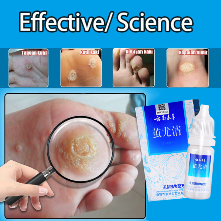 hard skin wart softener Foot Corn Warts cream 10ml corns get rid of