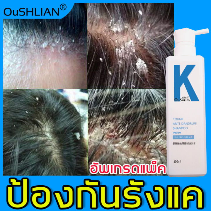 ป้องกันรังแค-ควบคุมความมัน-oushlian-แชมพูแก้ผมร่วง-ลดอาการคัน-แชมพูขจัดรังแค-ครีมนวดผม-ผม-บำรุงหนังศีรษะ-ครีมหมักผม-แชมพู