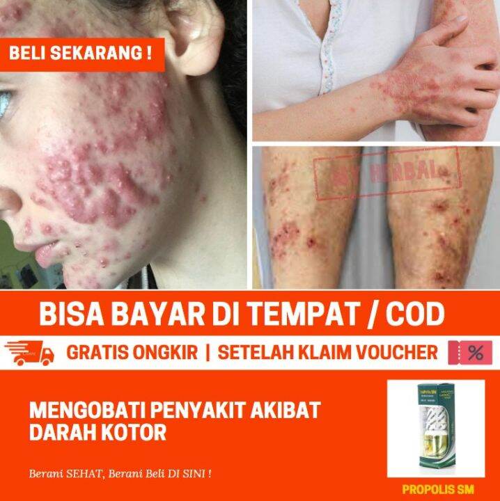 Obat Penyakit Prurigo Gatal Menahun Penghilang Bekas Luka Darah Manis