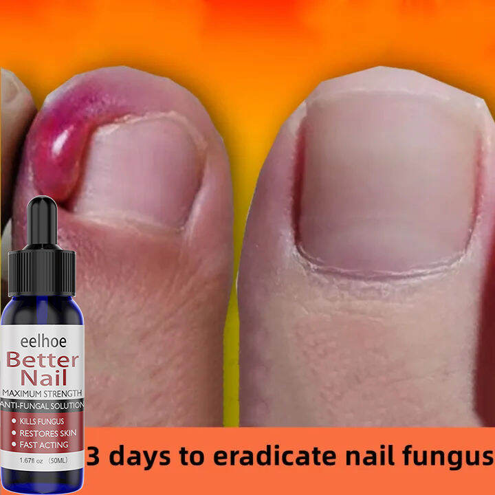 Eelhoe Nail repair treatment cream 50ml Nail treatment fungal Nail