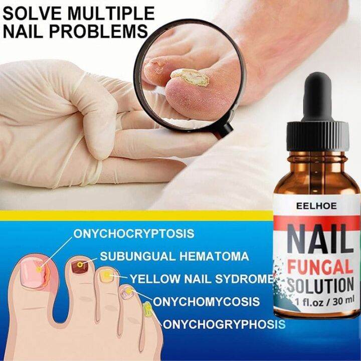 Effective Eelhoe Nail Fungal Solution Foot Nail Fungus Removal Gel Anti