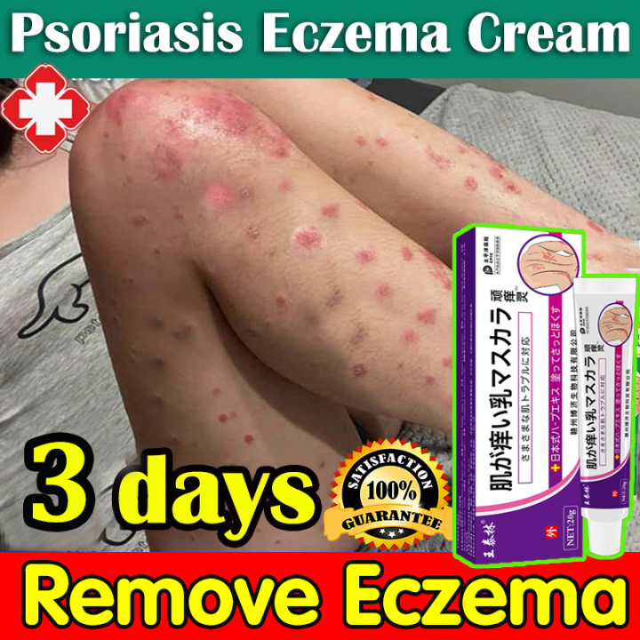 👍Original Japan Psoriasis Cream Ointment20g Eczema Ointment Chinese