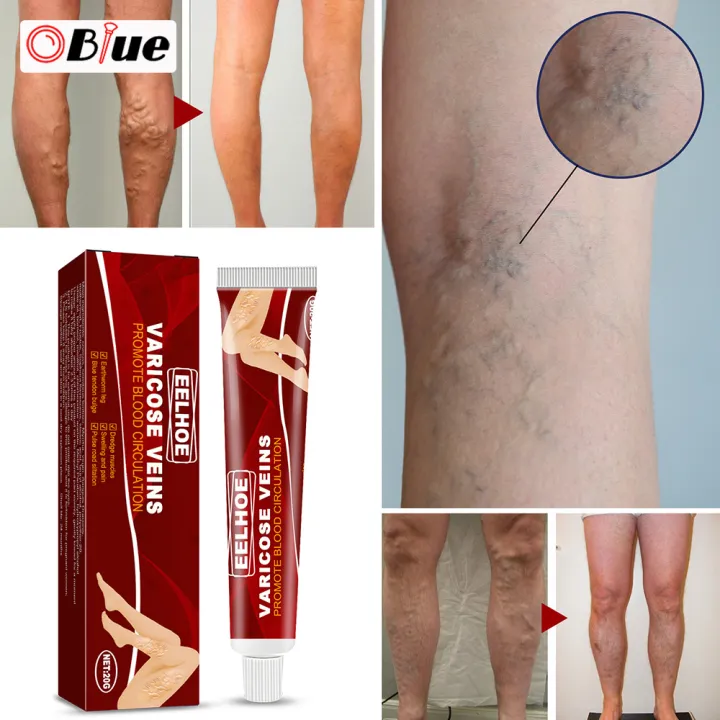 OBlue Varicose Vein Cream for Blood Vessel Swelling Leg Raised Vasculitis Phlebitis 20g Body
