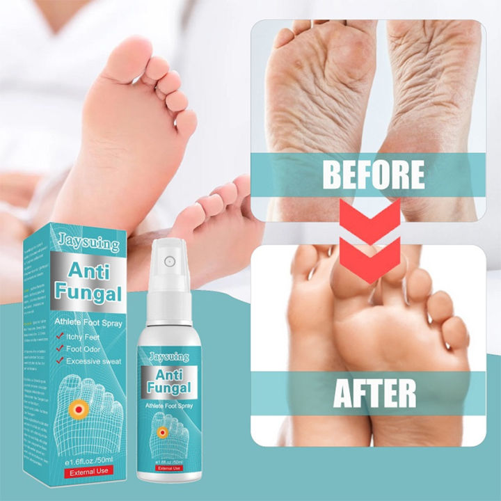 Anti Fungal Athlete Feet Spray Sterilize Toe Paronychia Foot Paronychia ...