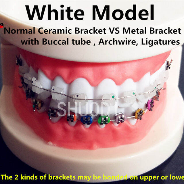 Dental Orthodontic Treatment Model With Ortho Metal Bracket Arch Wire