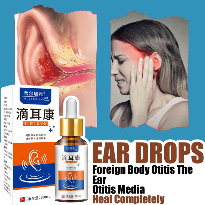 Nonirritating Otitis Media Ear Drops 30 ml Otitis media softens ear