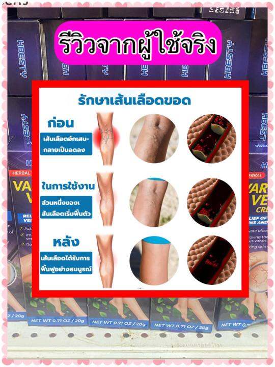 ส่งฟรี-hbesty-เส้นเลือดขอด20g-ครีมทาเส้นเลือดขอด-ครีมเส้นเลือดขอด-รักษาขาให้สวย