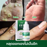 wart removal liquid เอสเซ้นลอกหูด 10ml ยาแต้มหูด ลอกหูดตาปลา ปลอดภัยไม่เจ็บตัว ขจัดติ่งเนื้อ เอสเซ้นลอกหูด ไม่ทิ้งร่องรอยป ครีมกําจัดไฝหูดติ่งเ