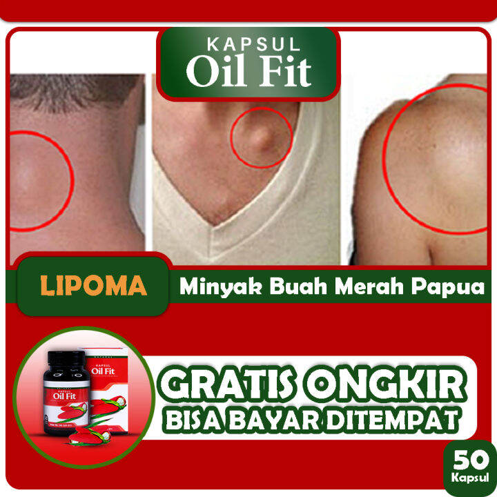 Obat Benjolan Di Leher, Benjolan Di Ketiak, Benjolan Di Payudara ...