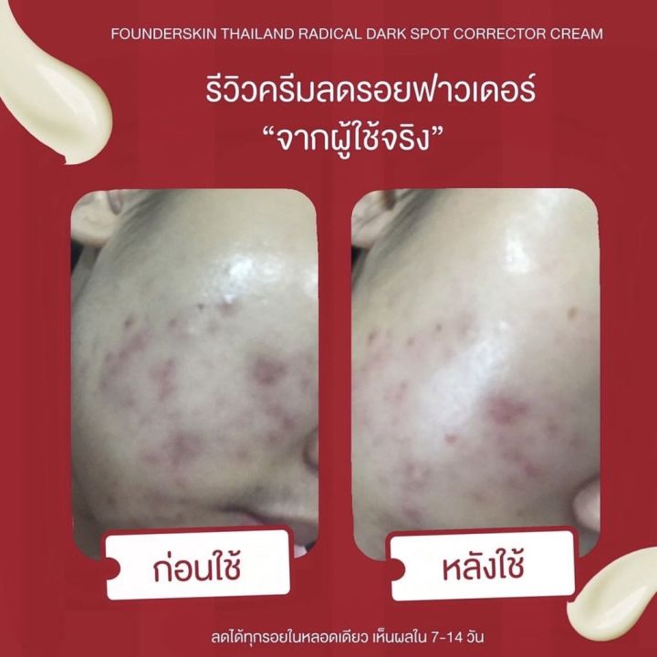 ครีมลดรอย-ฟาวเดอร์สกิน-founderskin-redical-dark-spot-corrector-cream-ลดรอยดำ-รอยแดง-ลบรอยแผลเป็น