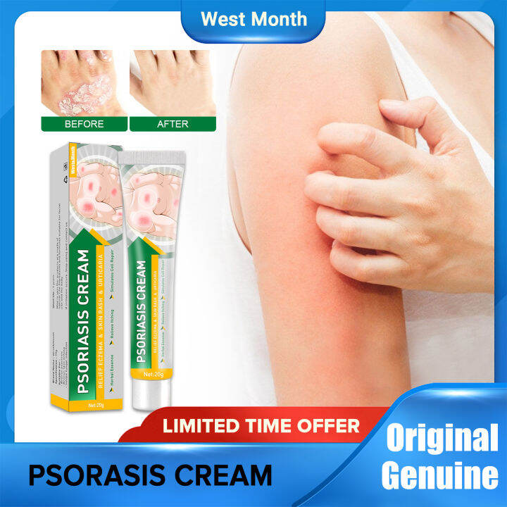 Psoriasis Eczema Cream Itching Cream Dermatitis Cream Eczema Treatment ...