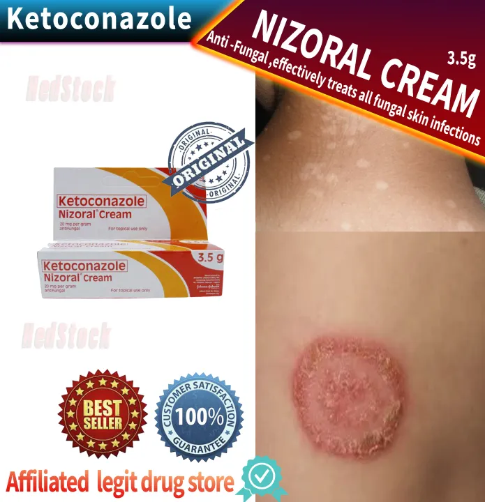 Nizoral Cream Treats All Fungal Skin Infections  Katikati Galis 