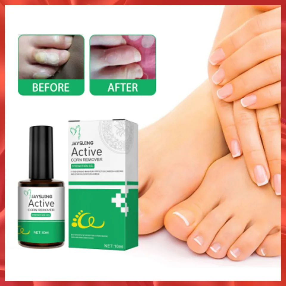 Skin Care Corn Removal Extra Strengthen Gel Foot Callus Treatment