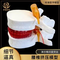 Lumbar amplification model extrusion outstanding demonstration spinal vertebrae pathological model of lumbar disc