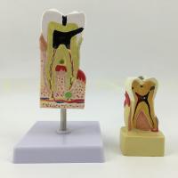 Human pathological tooth decay modulus tooth tooth structure anatomy of the tooth decay model disease comprehensive pathological model