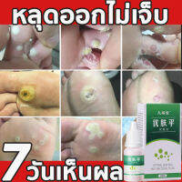 ลอกหูดตาปลา ติ่งเนื้อ เห็นผลทันทีเมื่อใช่ต่อเนื่อง Corns warts prickles calluses flat removal liquid เซรั่มแต้มหูด ลอกหูดตาปลา ปลอดภัยไม่เจ็บ