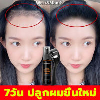 【หมดปัญหาผมร่วง】West&amp;Month สเปรย์ปลูกผม 30ml ดูแลหนังศีรษะ เร่งผมขึ้นใหม่ น้ำยาปลูกผมชาย ยาปลูกผมของแท้ เซรั่มบำรุงผม น้ำยาเร่งผมยาว ซรั่มปลูกผม ยาปลูกผมผู้ชาย เซรั่มปลูกผม เชรั่มปลูกผม น้ำยาใส่ผมขึ้น น้ำยาใส่ผม ปลูกผมเร่งด่วน เร่งการงอกใหม่ รากผมแข็งแรง