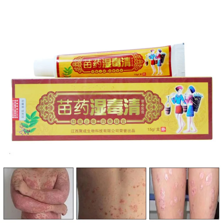 15g Fungus Anti Bacterial Cream Natural Chinese Herbs Cream Ointment ...