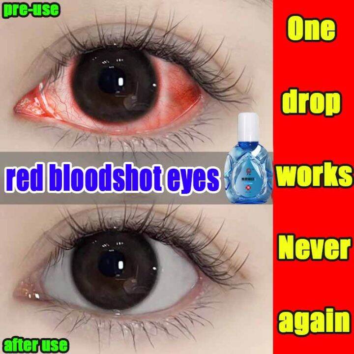 Eye Drops 眼药水 Blurred Vision Drop Itchy Dry Eye Drops Eyes Overuse eye