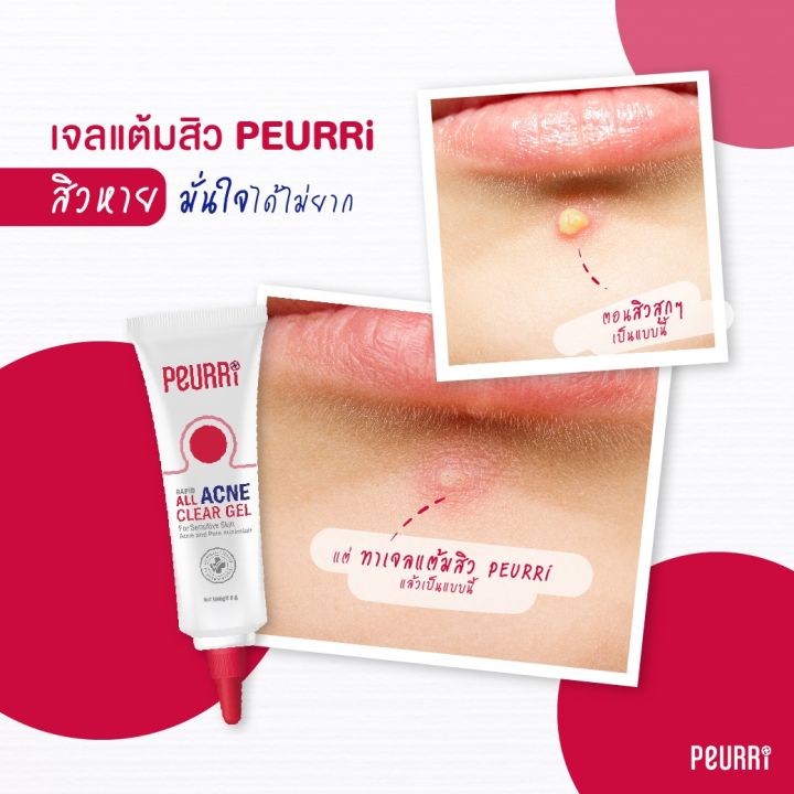 เจลแต้มสิว-peurri-all-acne-clear-gel-เพียวรี-แรพิท-ออล-แอคเน่-เคลียร์-เจล-3-หลอด