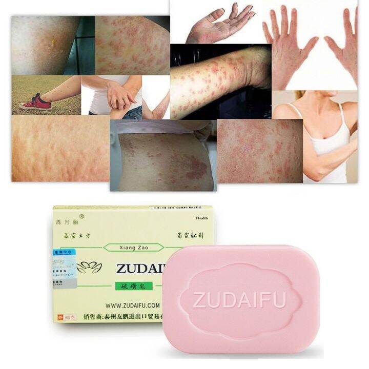 ZUDAIFU Sulfur Soap Anti Fungus Acne Psoriasis Seborrhea Eczema Bath