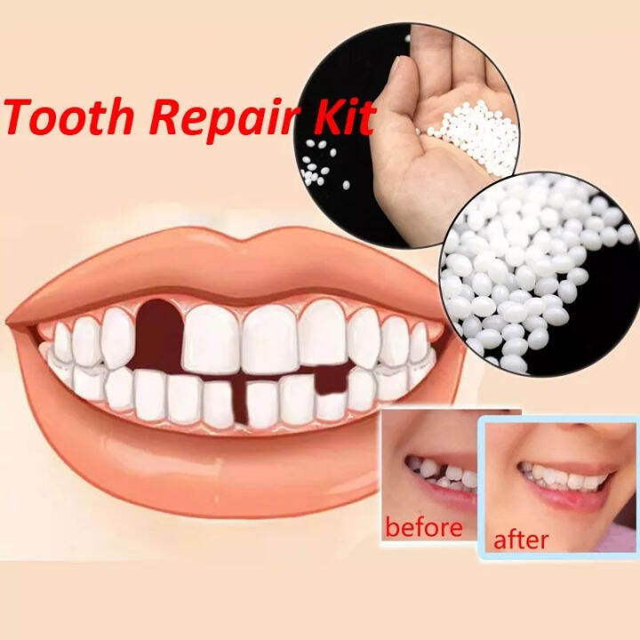Temporary 10g Resin Vampire Teeth Glue Tooth Replacement Material Tooth