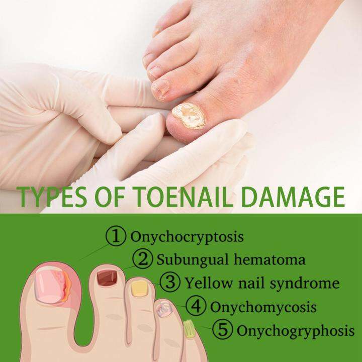 Safe Toenail Treatment Liquid Nail Formula Hydrating Reduce Nail