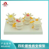 Bloggers human body skeleton model orthopaedic teaching medical lesions in lumbar spine model