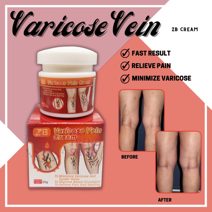 ZB Varicose Vein Cream Effective Cure For Legs Varicosity Spider