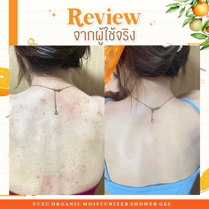 พร้อมส่ง-ลดสิวที่หลัง-เจลอาบน้ำมิวซุ-organic-มี-biosol-ช่วยฆ่าเชื้อสิว-ลดรอยดำ-ผดผื่น-สิวหลัง-สิวหน้าอก