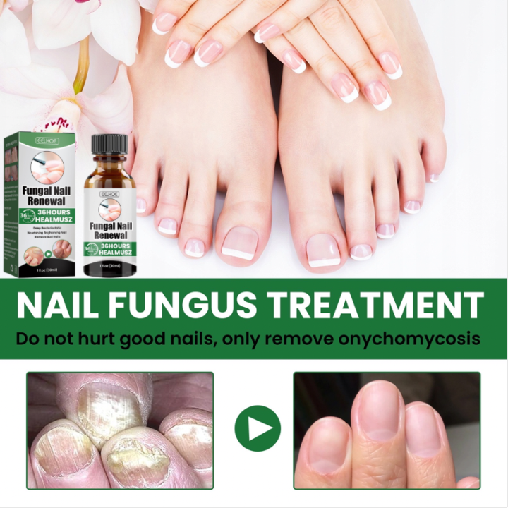 COD Nail Repair Essence Serum Inhibit Fungal Nail Infections Fungal ...