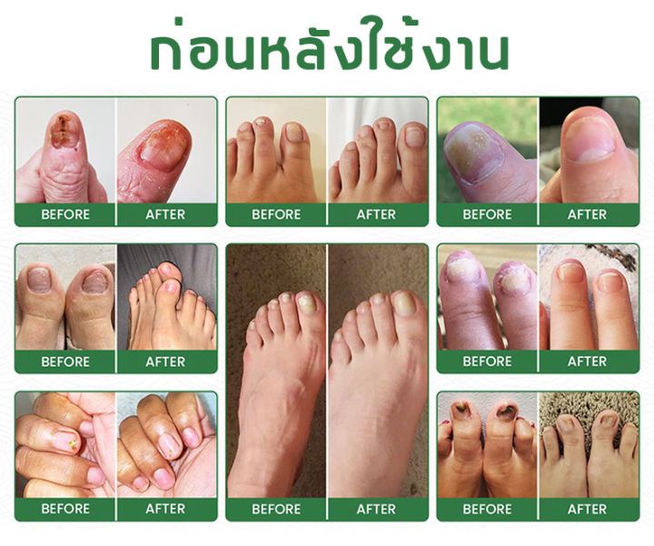 tanksen-เซรั่มบำรุงเล็บ-30ml-ซ่อมเล็บที่ชำรุด-น้ำยาซ่อมแซมเล็บ-น้ำยาแก้ปัญหาเล็บ-ดูแลเล็บ-เซรั่มเล็บ-เซรั่มซ่อมแซมเล็บ-เชื้อราเล็บมือ-สำหรับเชื้อราที่เล็บ-น้ำยาบำรุงเล็บ-เชื้อราเล็บ-เล็บเสีย-แก้ปัญหาเ