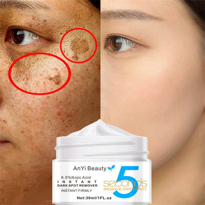 BFdikou AnYi Beauty kojic acid black spot removal cream cream skin