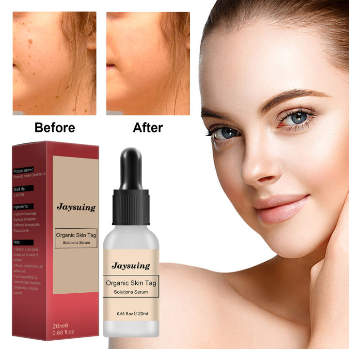 Jaysuing Mole Removal Solution Repair Mole Removal Black Spot Body Mole ...