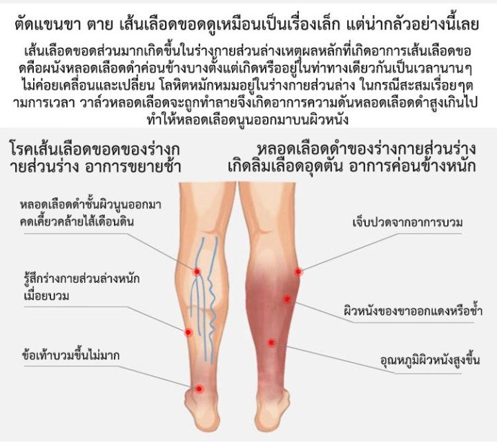 juscomart-ถุงเท้าสำหรับคนเส้นเลือดขอด