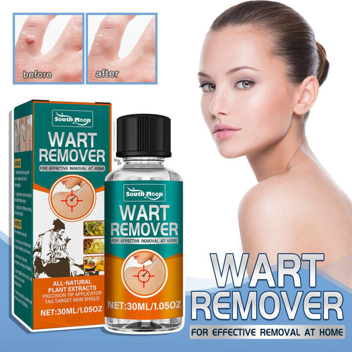 Wart Removal Liquid Fast Wart Removal on Legs Skin Tag Clearing