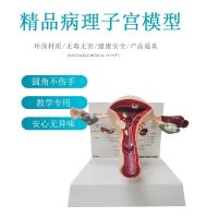 Human anatomy model uterine lesions in female reproductive system in reproductive structure of department of gynaecology egg display AIDS