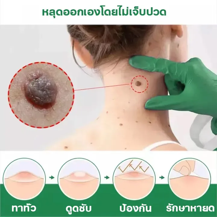 ขี้แมลงวัน-หูดตาปลาและติ่งเนื้อ-ของแท้-corns-warts-removal-พร้อมส่ง-ไฝ-ครีมแต้มหูด-ลอกหูดตาปลา-ปลอดภัยไม่เจ็บ