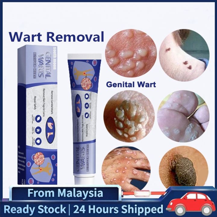 Ubat Buang Kutil Ketuat Tahi Lalat Biji Kolestrol Wart Removal Ointment Wart Cream Warts Skin