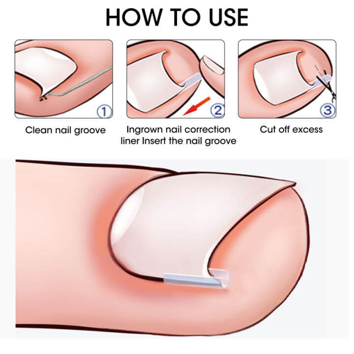 Toenail Correction set Pad Glue Extractor Nipper Ingrown Toe Nail