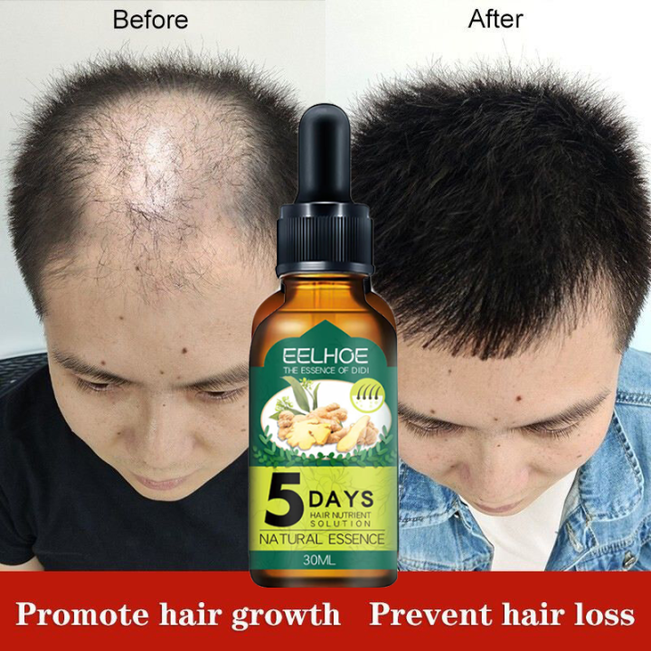 5 days effective ginger hair regrowth serum for men women original ...