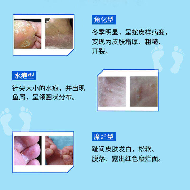 Weidaning athlete's foot spray econazole nitrate spray 80ml foot odor