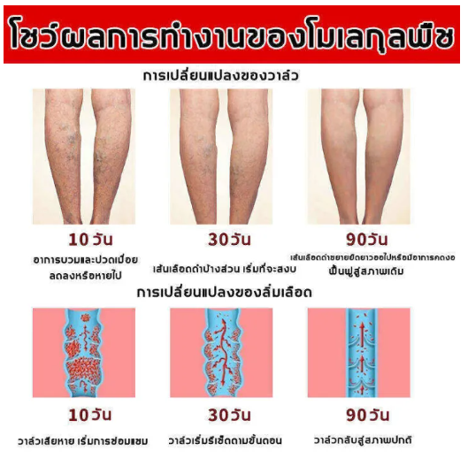 ผู้ขายในท้องถิ่น-sefudun-ยาทาเส้นขอด-เส้นเลือดขอด-50g-ครีมหลอดเลือดดำบอกลาเส้นเลือดขอด-ครีมทาเส้นเลือดขอด-แมงมุมเส้นเลือดปวด-ครีมเส้นเลือดขอด-ยาทาเส้นเลือดขอด-varicose-vein-cream