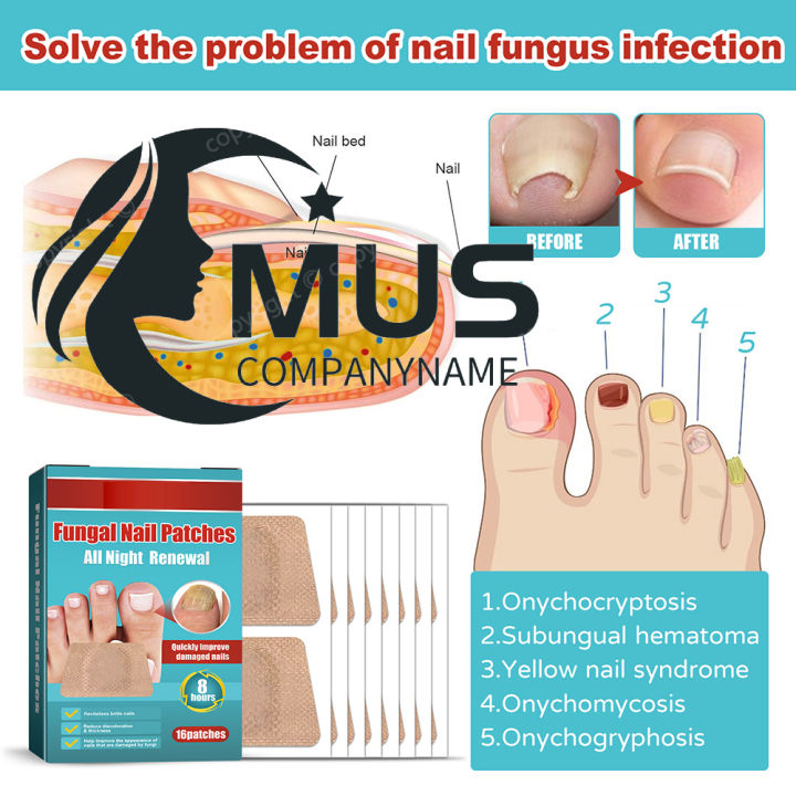 mus-สติกเกอร์การแก้ไขเล็บแผ่นติดเล็บ-grey-breathable-nail-paronychia-ซ่อมแซมเล็บ