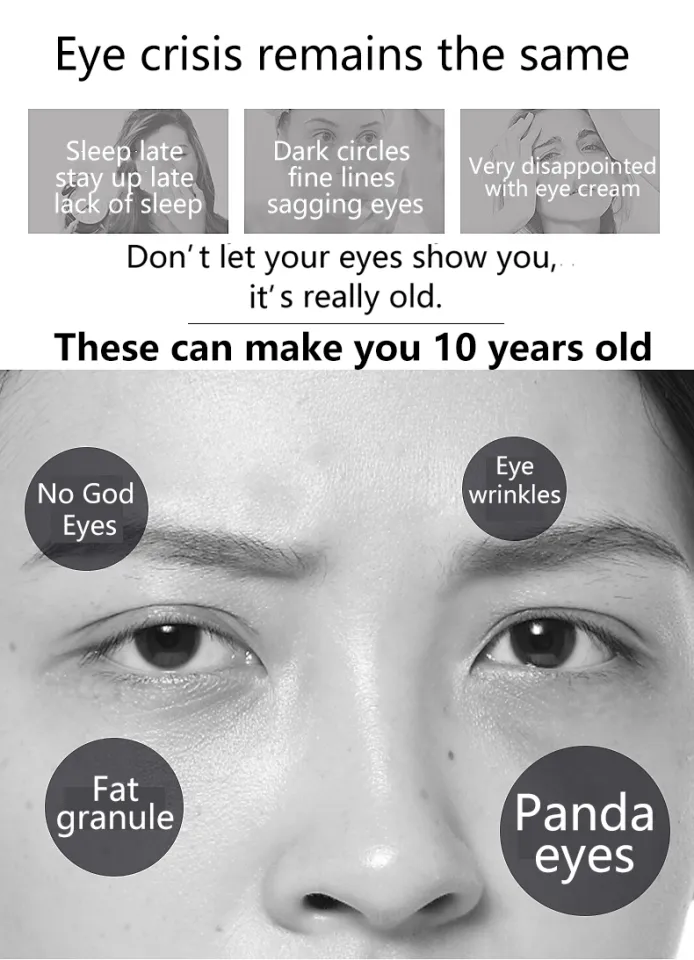 Update more than 131 bags under my eyes meme latest esthdonghoadian