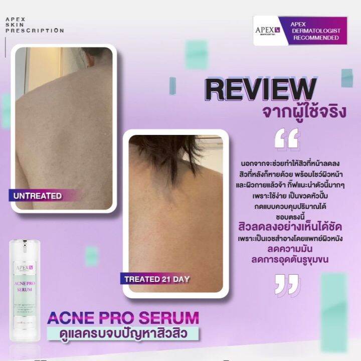 apex-sx-acne-pro-serum-เซรั่มรวมการดูแลปัญหาต่างๆ-ของการเกิดสิวไว้ในขวดเดียว-เหมาะสำหรับคนเป็นสิว-อ่อนโยนมาก-30-ml