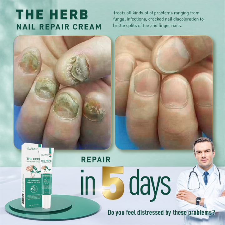 nail fungus treatment nail repair treatment cream essence footurel gel