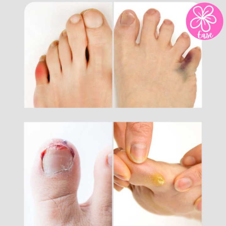 ปลอกนิ้วซิลิโคน-ซิลิโคนสวมนิ้วเท้า-ซิลิโคนสวมนิ้วมือ-ลดการเสียดสี-และการบาดเจ็บที่นิ้วมือ-เท้า-2ชิ้น